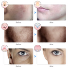 AcneClear™ LED Light Therapy Mask